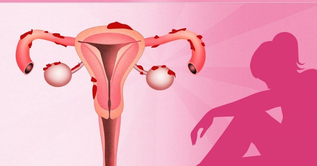 ¿Que es la endometriosis? Sintomas, tratamiento y consecuencias