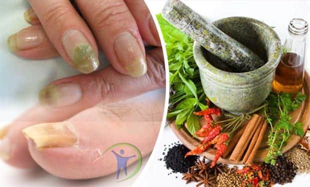 10 Remedios naturales para la onicomicosis en uñas de manos y pies
