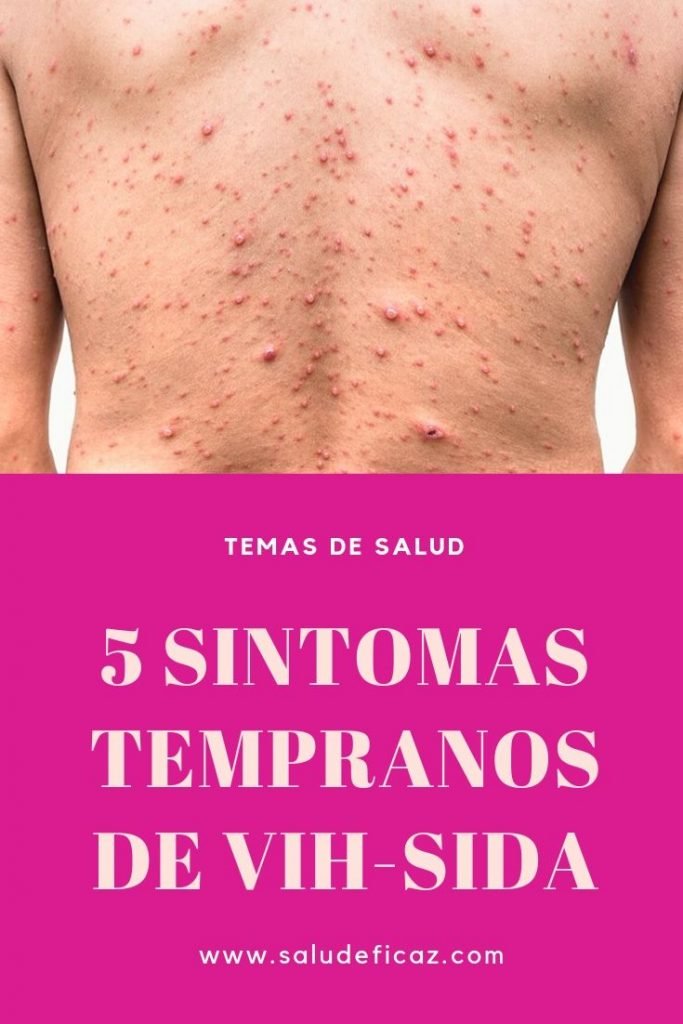 5 Sintomas Tempranos De Infección Por Vih