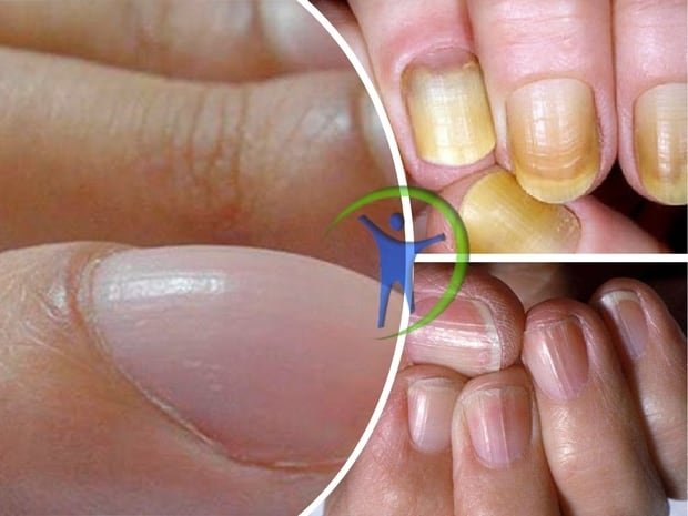 10 síntomas que las uñas revelan tu estado de salud