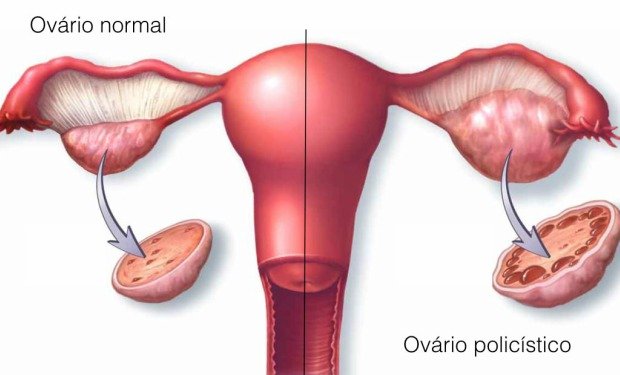 Ovarios poliquísticos Causas, Síntomas y Tratamientos