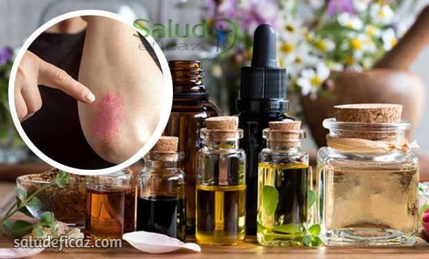 mezcla de aceites esenciales para tratar la psoriasis
